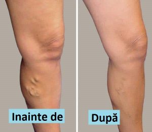 exerciii pentru picioare cu vene varicoase în picioare cum sa înlocuii squats varicoza